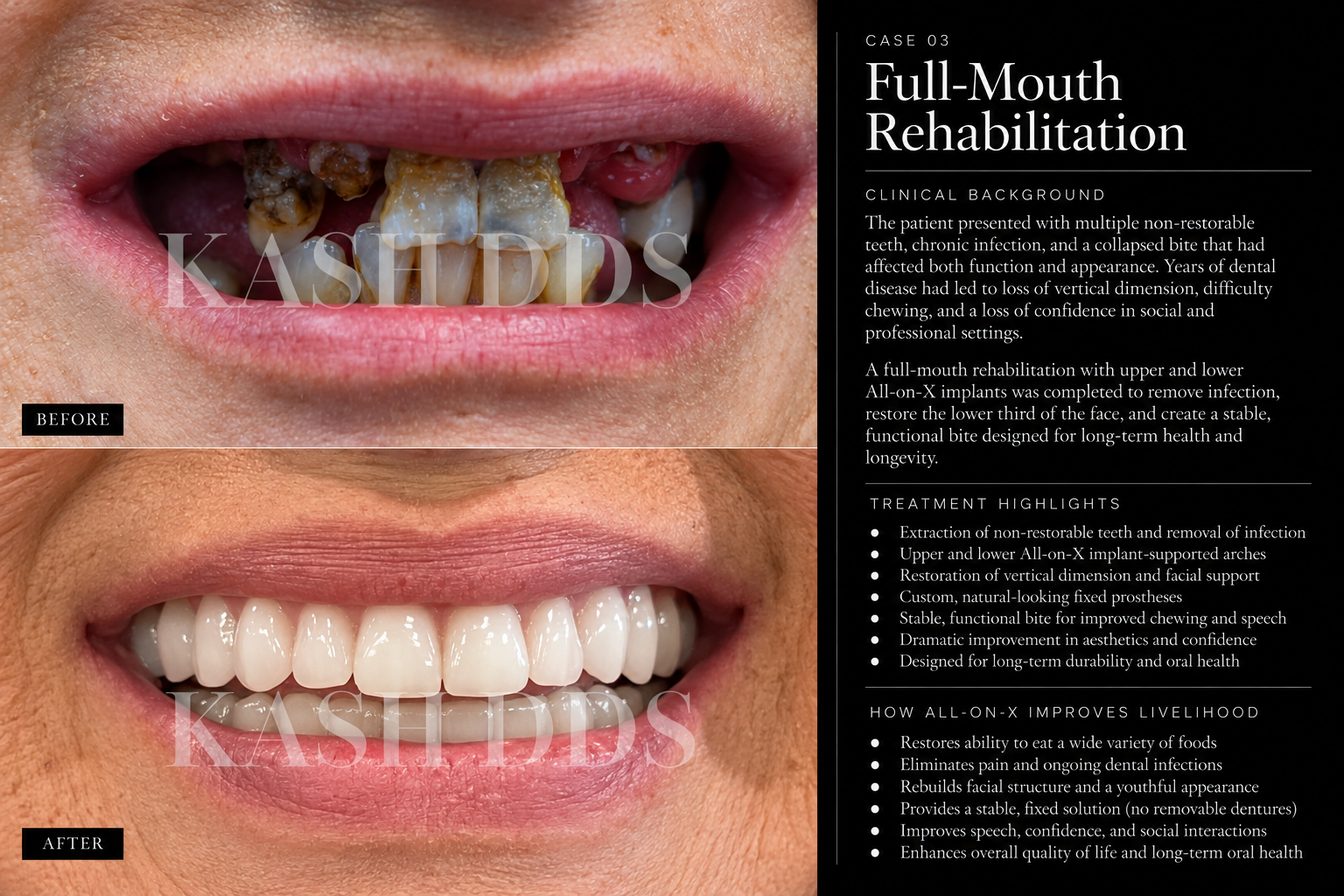 Case 03 before and after rehabilitation